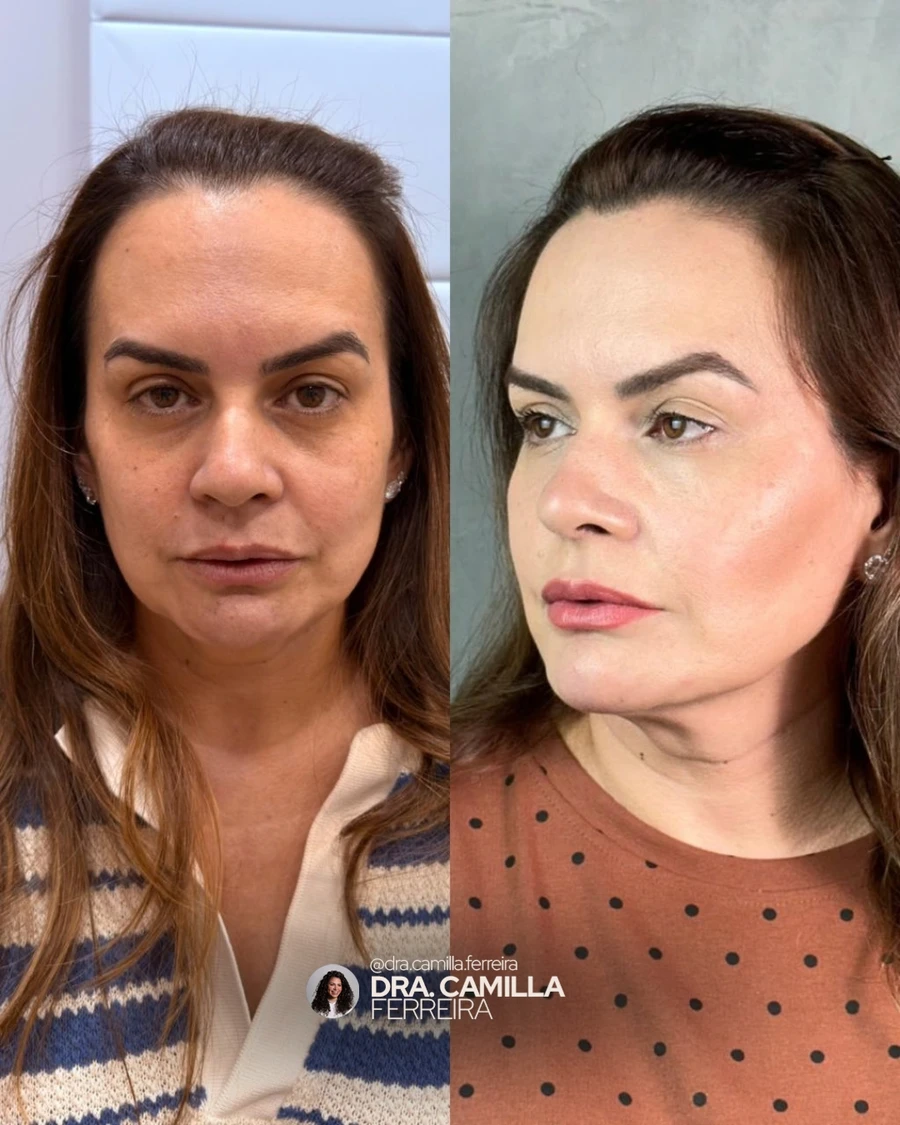 Montagem de antes e depois compartilhada pela Dra. Camilla, registro 01